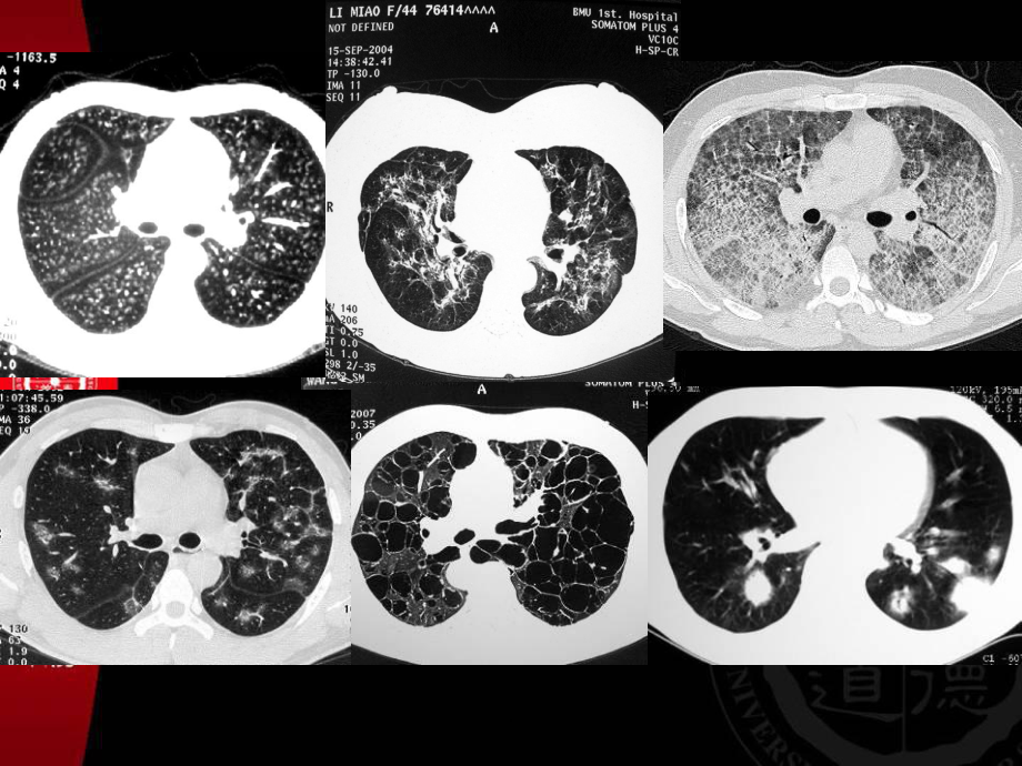 肺弥漫性疾病-多发结节样病变HRCT分析课件.ppt_第3页