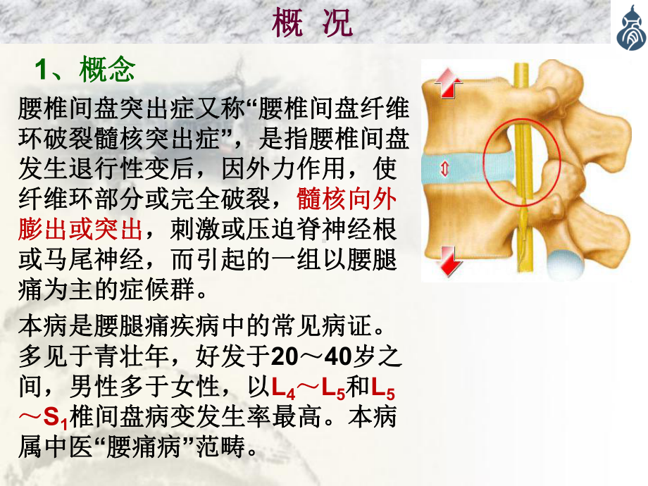 腰椎间盘突出症最全内容-SS课件.ppt_第3页