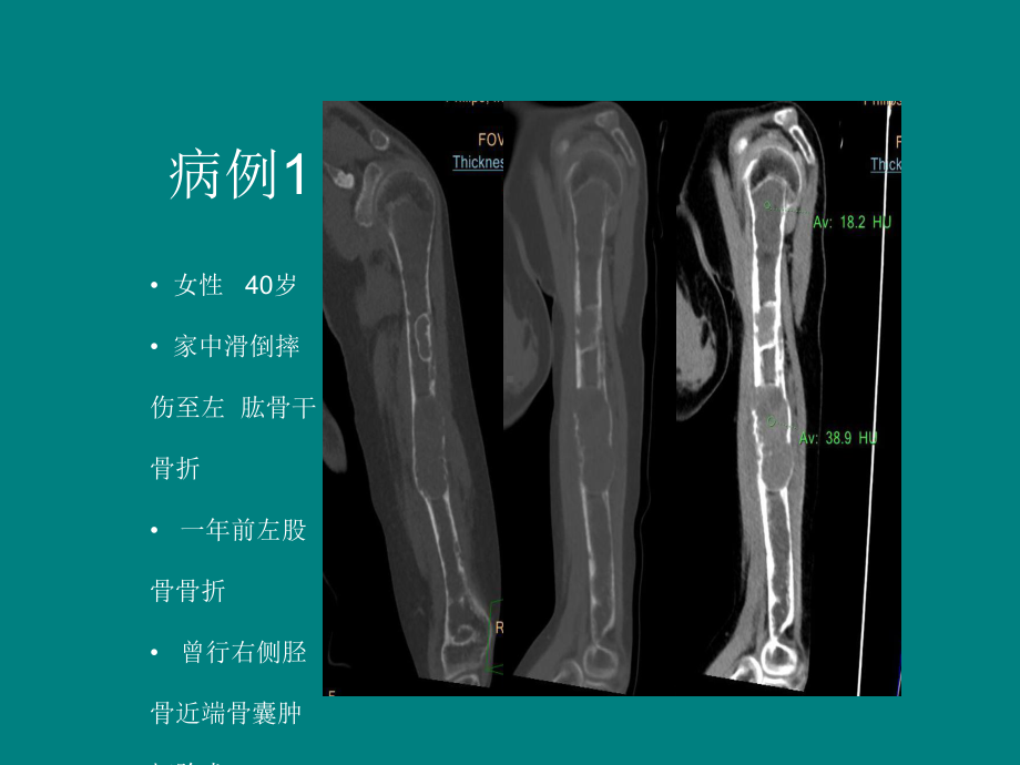 甲状旁腺亢进棕色瘤的影像诊断课件.ppt_第2页