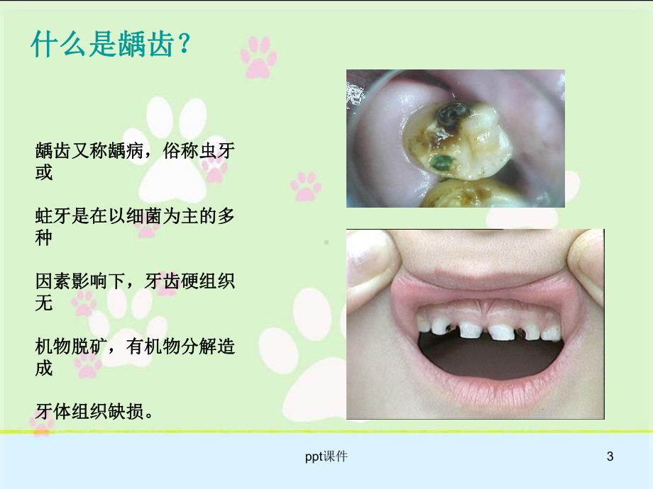 儿童龋齿-课件.ppt_第3页