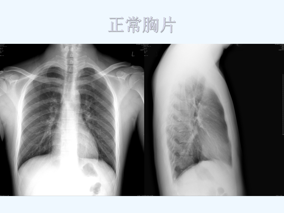 肺部常见炎性病变课件.ppt_第2页