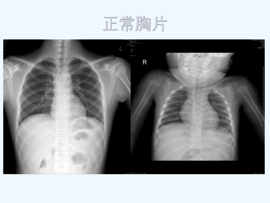 肺部常见炎性病变课件.ppt_第3页