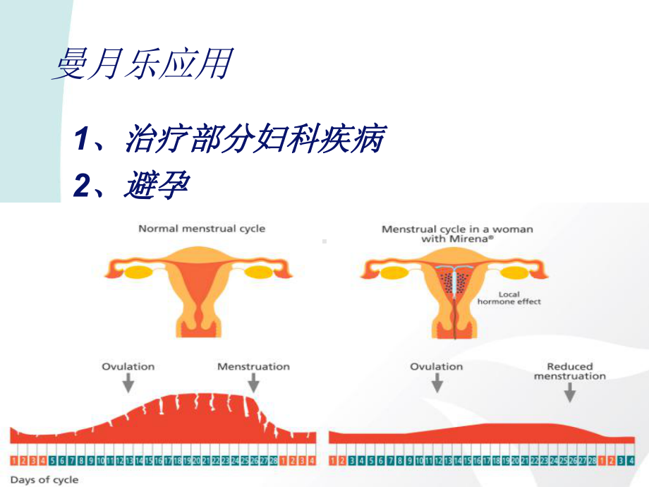 曼月乐临床应用课件.pptx_第2页