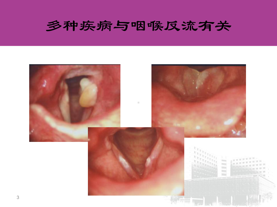 阻塞性睡眠呼吸暂停低通气综合征与反流病的关系课件.ppt_第3页