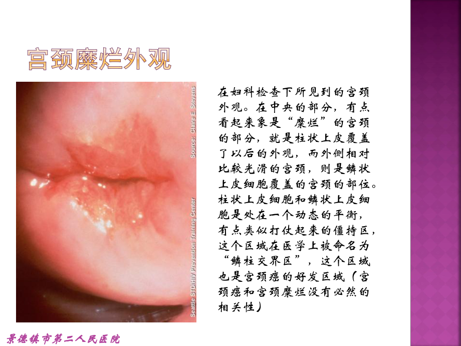 宫颈疾病课件.ppt_第3页