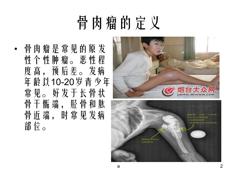 骨肉瘤患者的护理查房课件.ppt_第2页