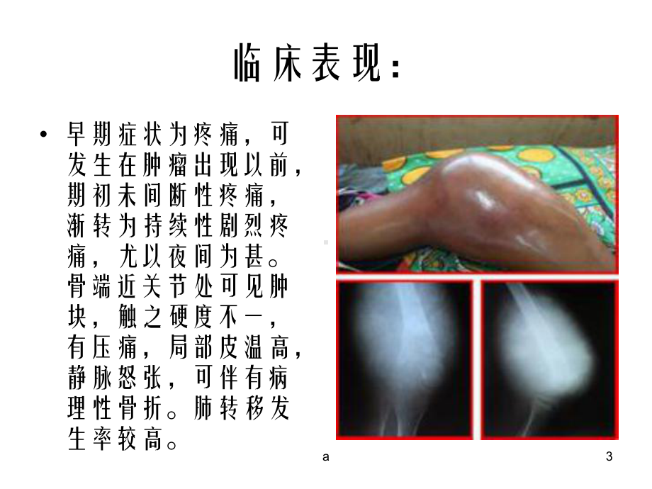 骨肉瘤患者的护理查房课件.ppt_第3页