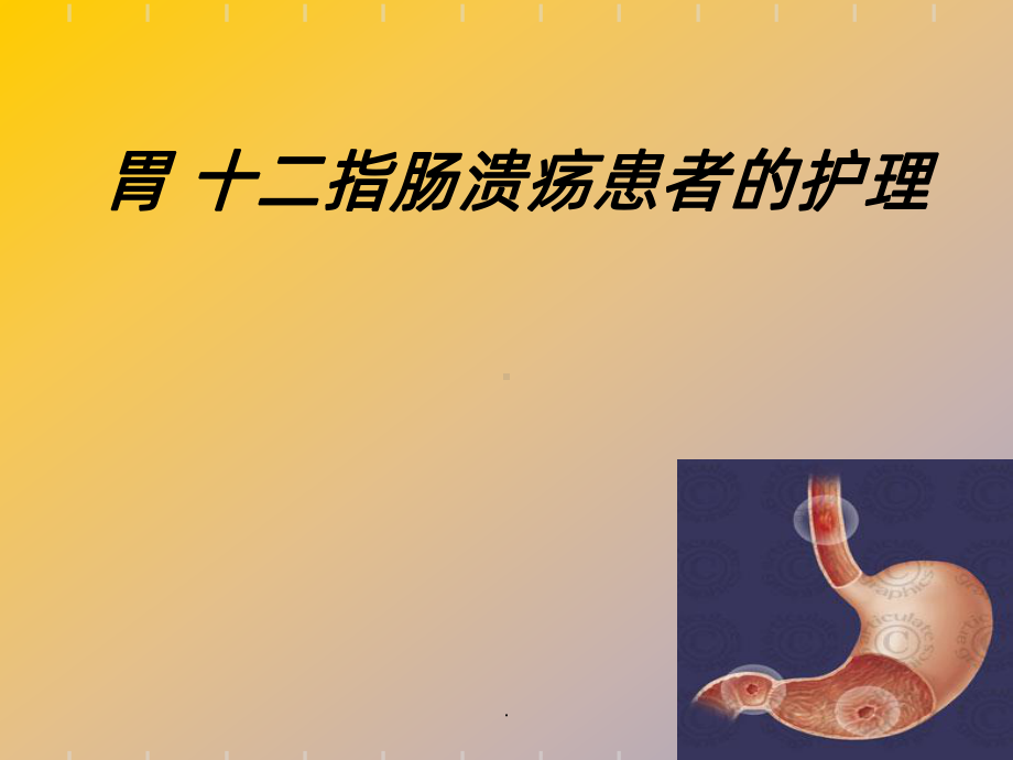 《胃十二指肠溃疡》课件.ppt_第1页