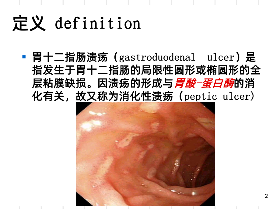 《胃十二指肠溃疡》课件.ppt_第2页