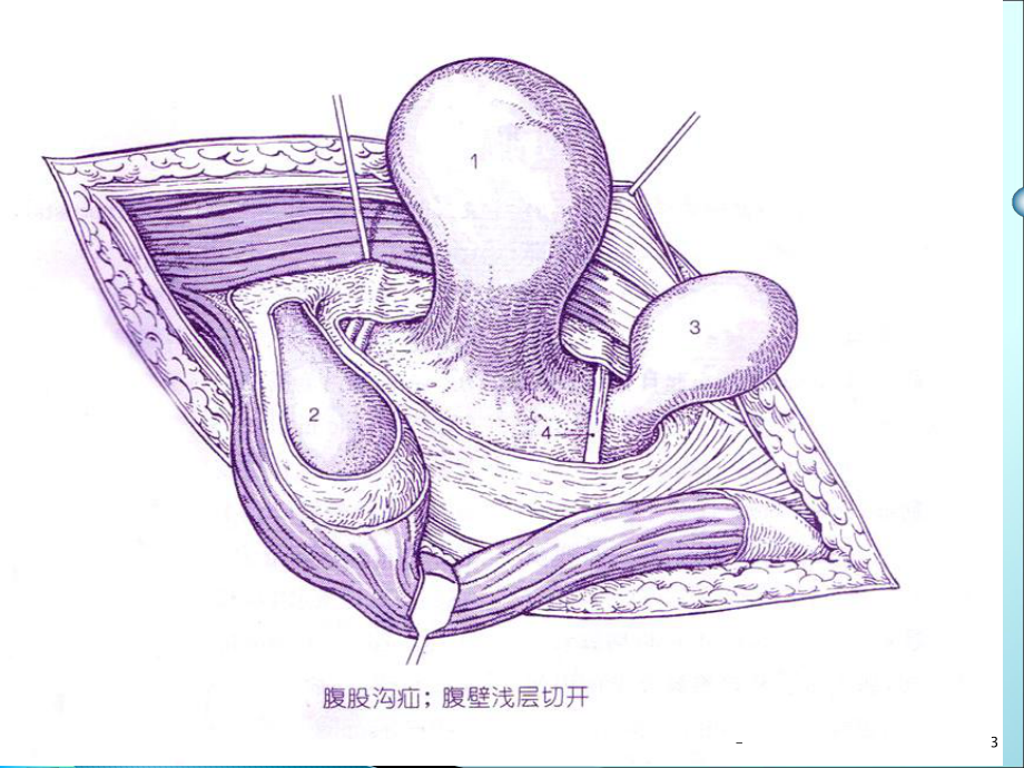 腹股沟疝课件.pptx_第3页