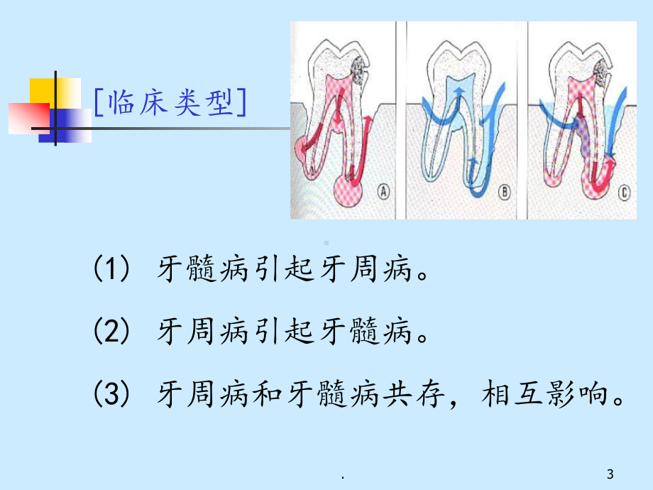 牙周炎伴发病变、牙周病治疗课件.ppt_第3页