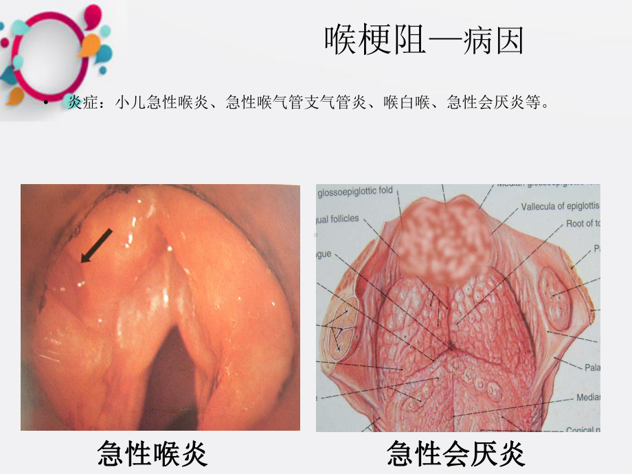 《喉梗阻教学》课件.ppt_第3页