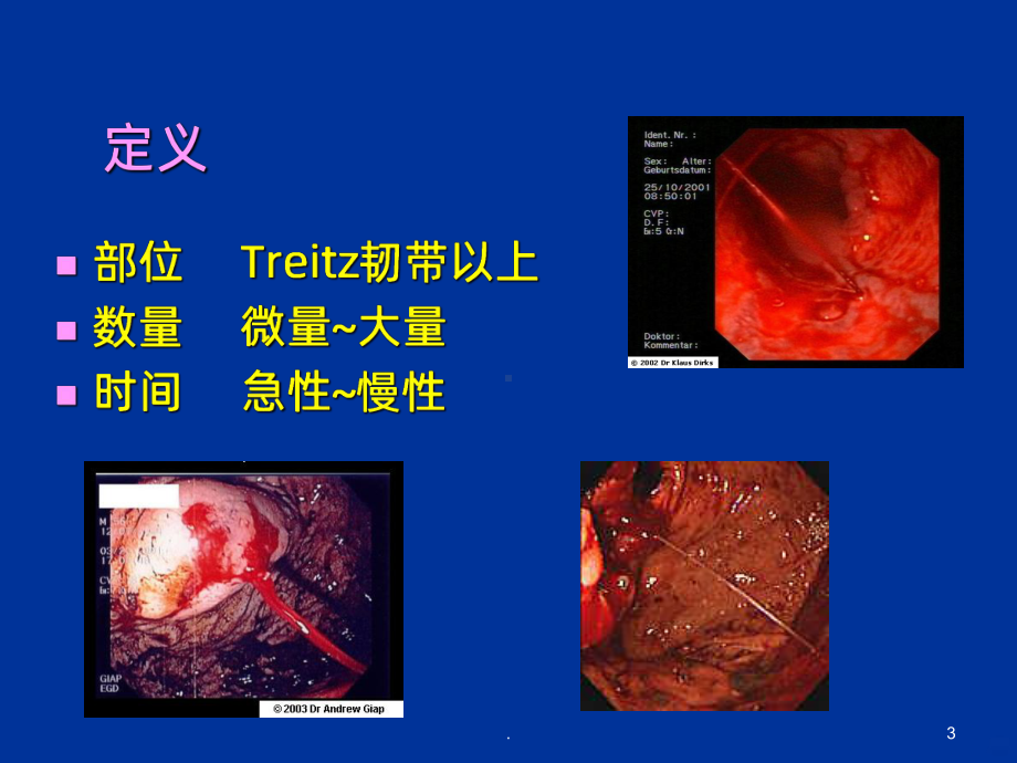 上消化道出血诊治课件.ppt_第3页