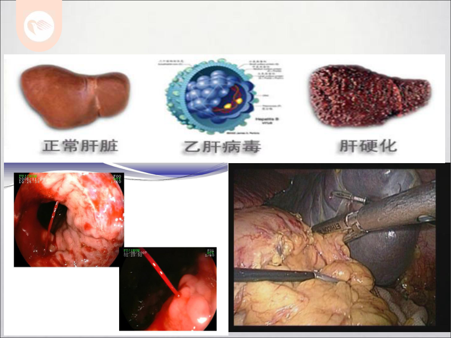 腹腔镜门奇断流+脾切术的操作及并发症课件.ppt_第3页