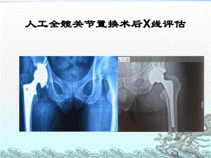 髋关节置换术后X线评估课件.ppt