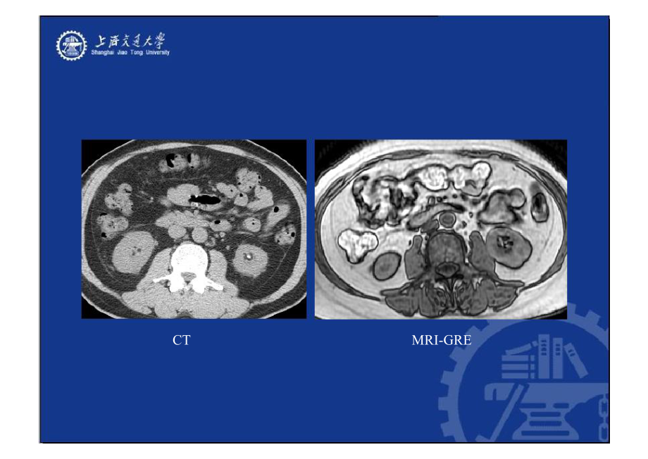 腹膜后间隙病变的影像诊断课件.ppt_第3页