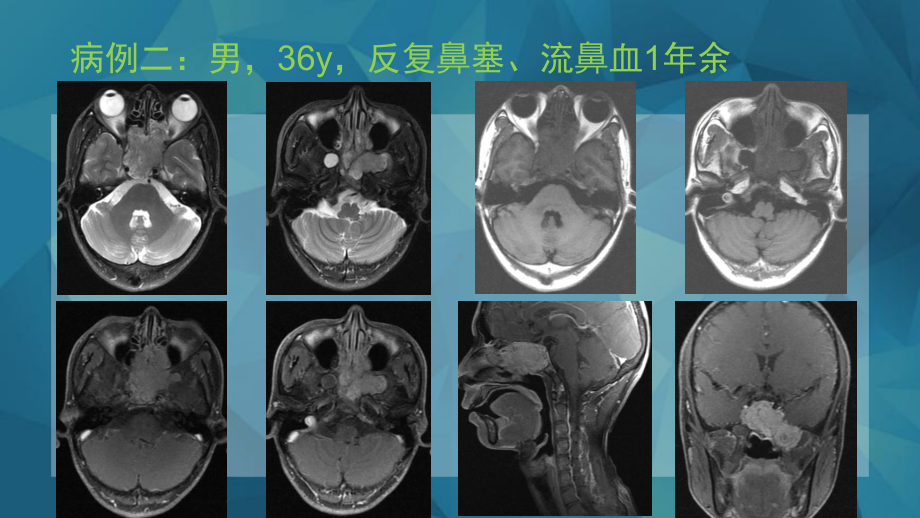 鼻咽纤维血管瘤-严文杰课件.pptx_第2页