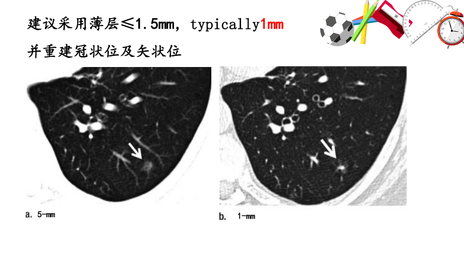 偶发肺结节的处理原则课件.pptx_第3页