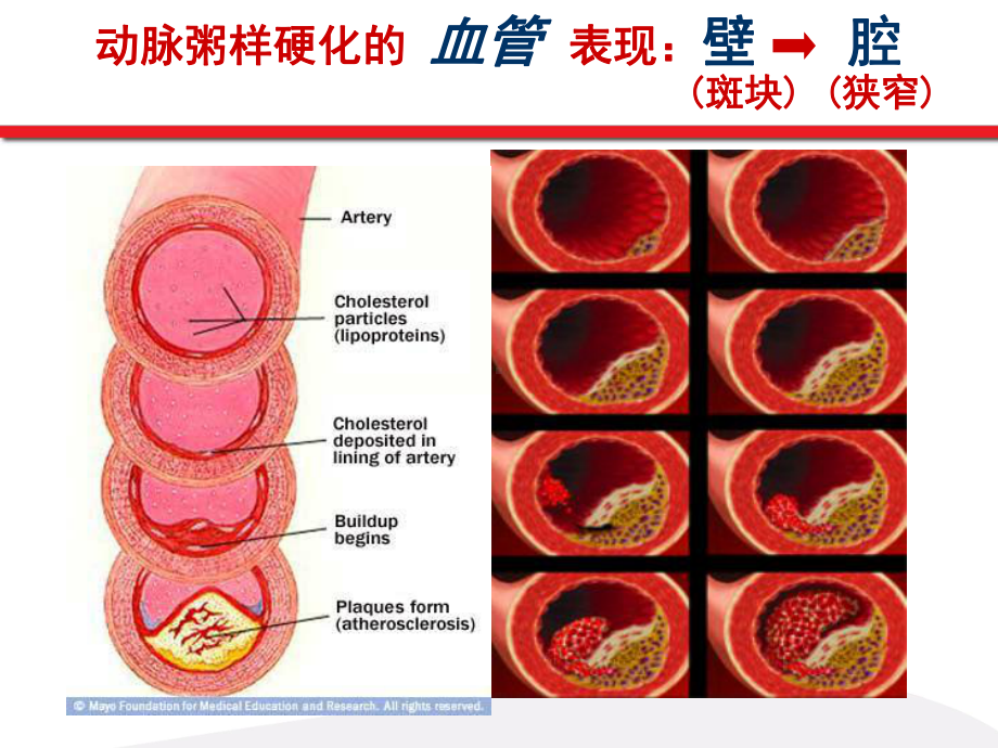 血脂异常与动脉粥样硬化斑块-郭远林课件.ppt_第3页