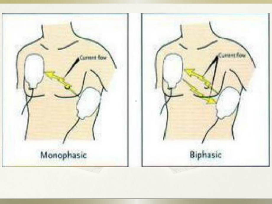 飞利浦除颤仪的使用-陈国富课件.ppt_第3页