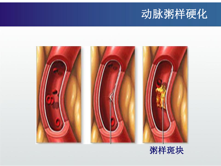 冠心病患者的护理课件.ppt_第3页