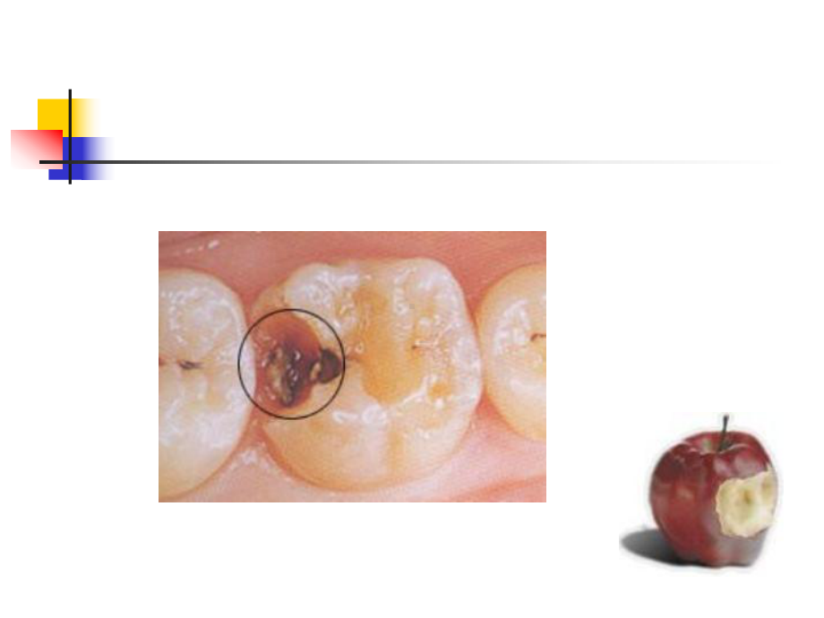 龋病的病因学说课件.ppt_第3页