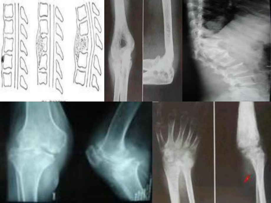 骨关节结核病人的护理课件.ppt_第2页