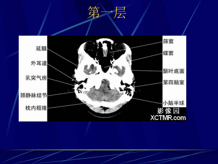 脑出血、脑梗塞、脑软化灶CT病例课件.ppt_第3页