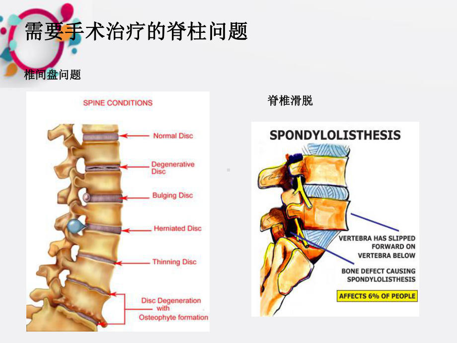 《脊柱手术的麻醉》课件.ppt_第2页