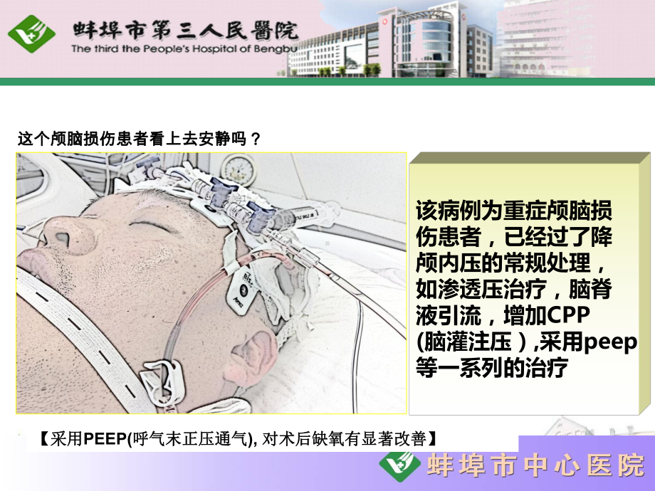 重症脑损伤患者的镇痛镇静治疗课件.ppt_第2页