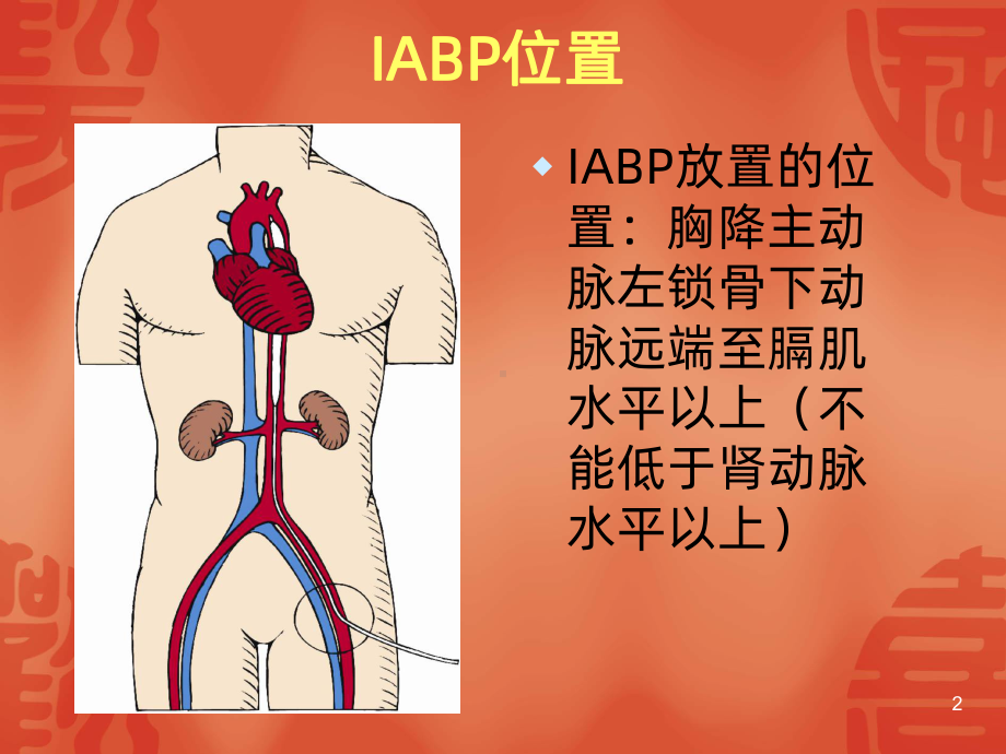 IABP的护理要点课件.ppt_第2页