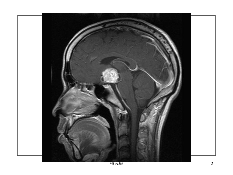 颅咽管瘤-临床病例分析课件.ppt_第2页