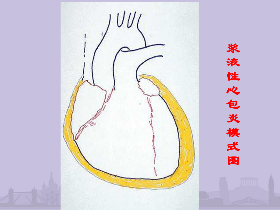 第内科学心包积液及心脏压塞课件.pptx_第3页