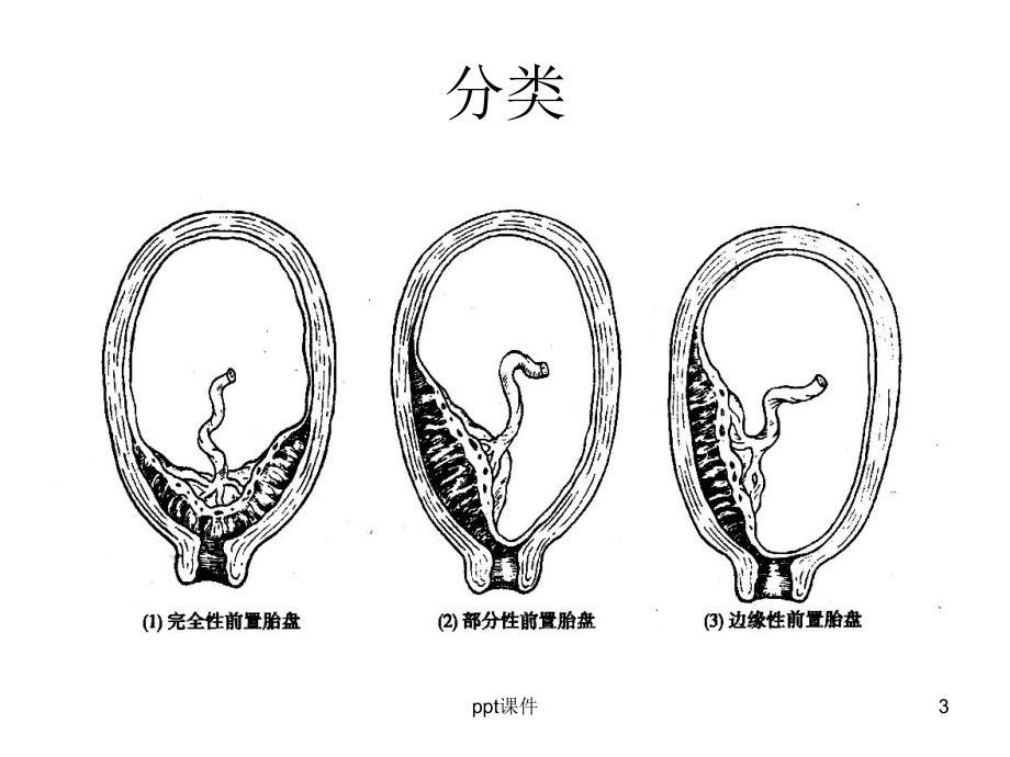 前置胎盘护理-课件.ppt_第3页