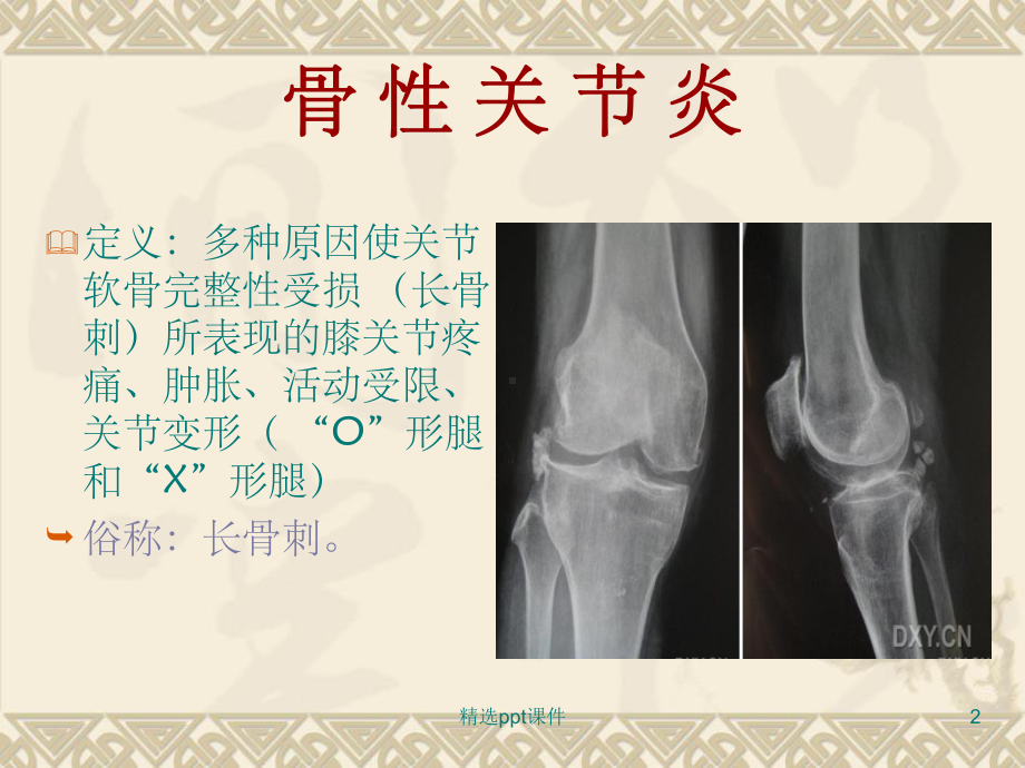 《膝关节病健康教育》课件.ppt_第2页