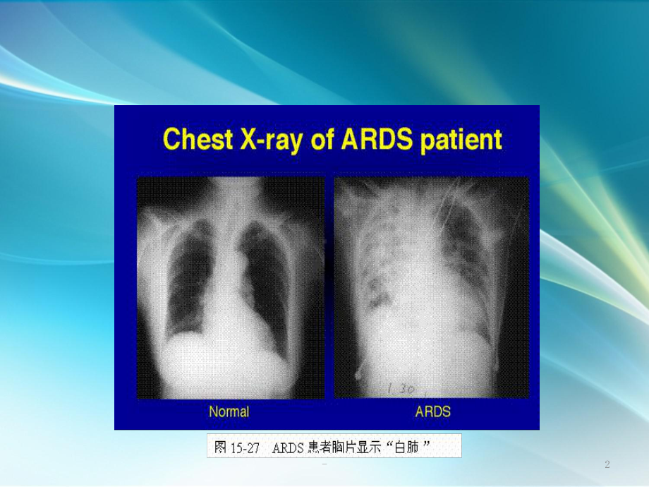 ARDS课件讲稿课件.ppt_第2页