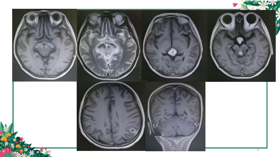 颅内生殖细胞瘤课件.pptx_第3页