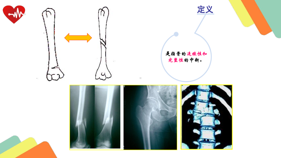 骨折病人的护理课件.pptx_第2页