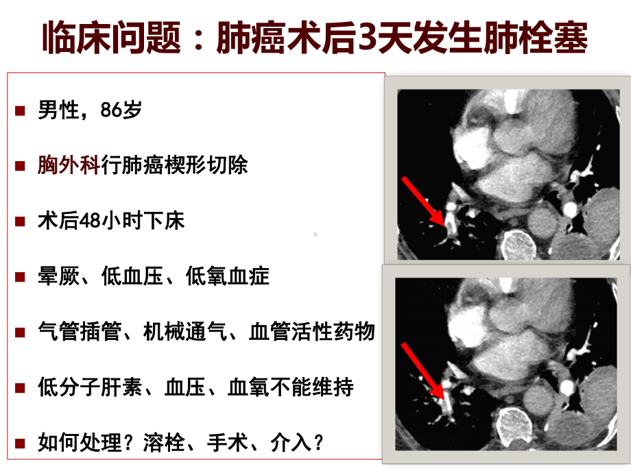 医院管理案例应用PDCA模式持续推进医院内肺栓塞防治与管理课件.ppt_第2页