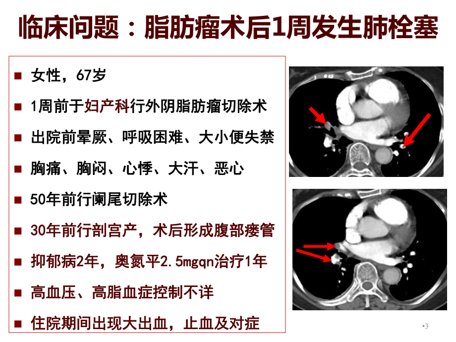 医院管理案例应用PDCA模式持续推进医院内肺栓塞防治与管理课件.ppt_第3页