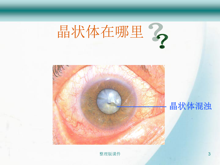 白内障相关知识健康宣教课件.ppt_第3页