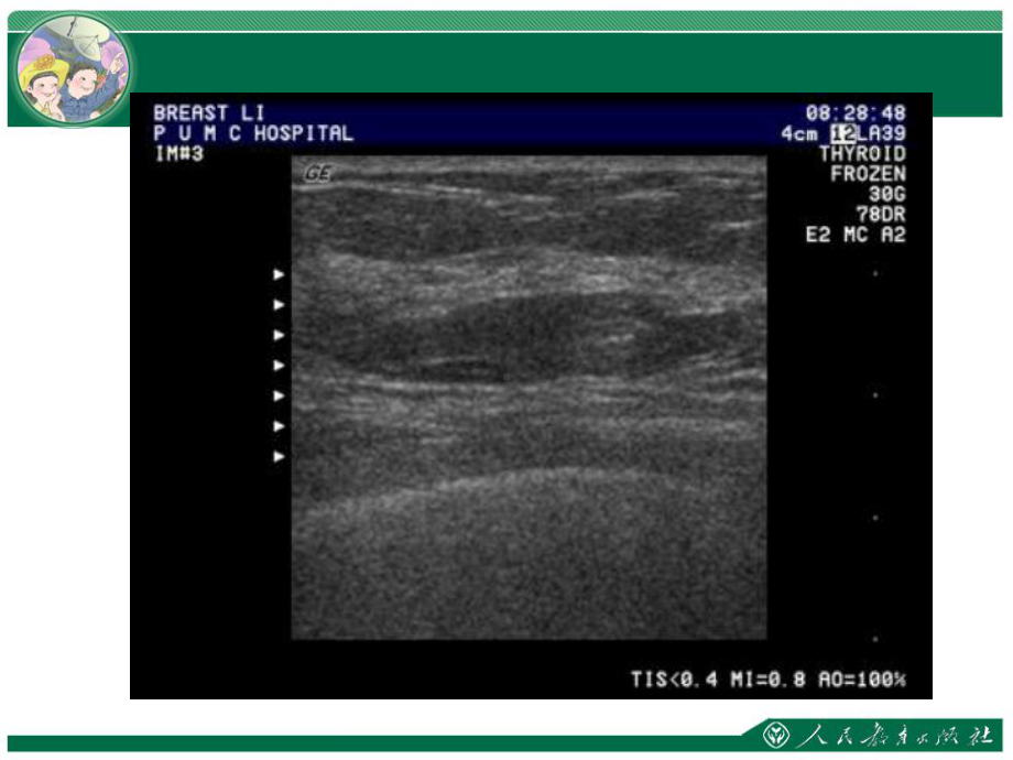 《乳腺超声》课件.ppt_第3页