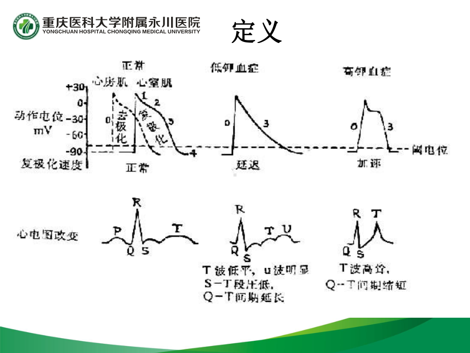 高钾血症的紧急处理课件.ppt_第3页