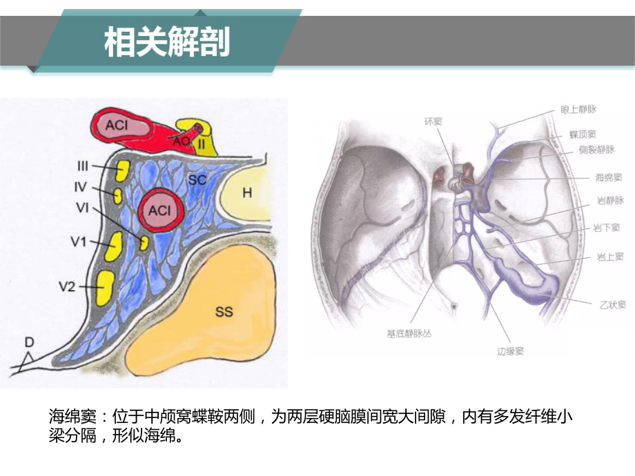 颈动脉海绵窦瘘CT及MRI表现课件.ppt_第3页