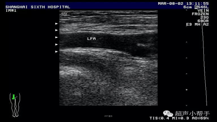 四肢血管超声诊断-课件.ppt_第2页
