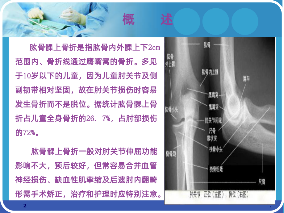 儿童肱骨髁上骨折田课件.ppt_第2页