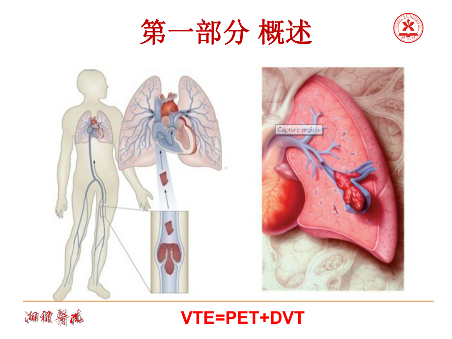 肺血栓栓塞症诊治与预防-2021指南解读课件.ppt_第3页