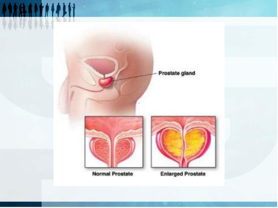 前列腺增生护理-课件.pptx_第3页