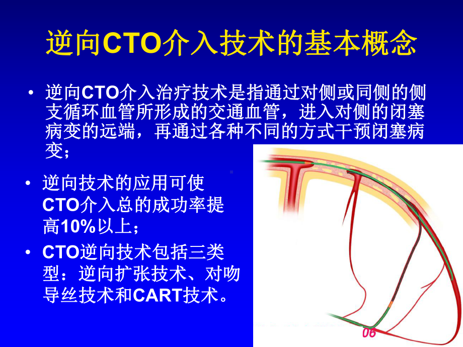 正向和逆向cto病变介入技术的选择陈纪言课件.pptx_第3页