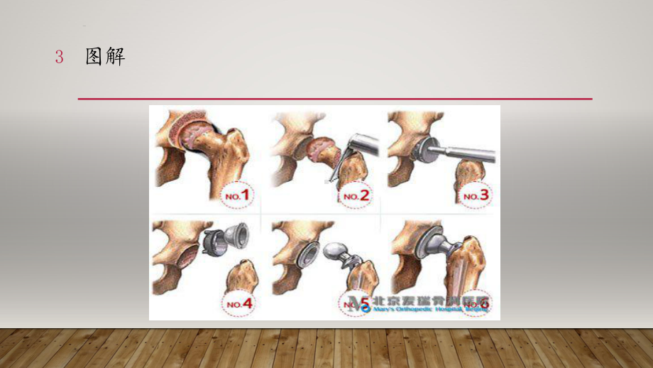 髋关节置换术后康复课件.pptx_第3页